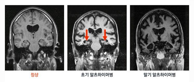 그림 - 경과에 따른 알츠하이머병 MRI 사진